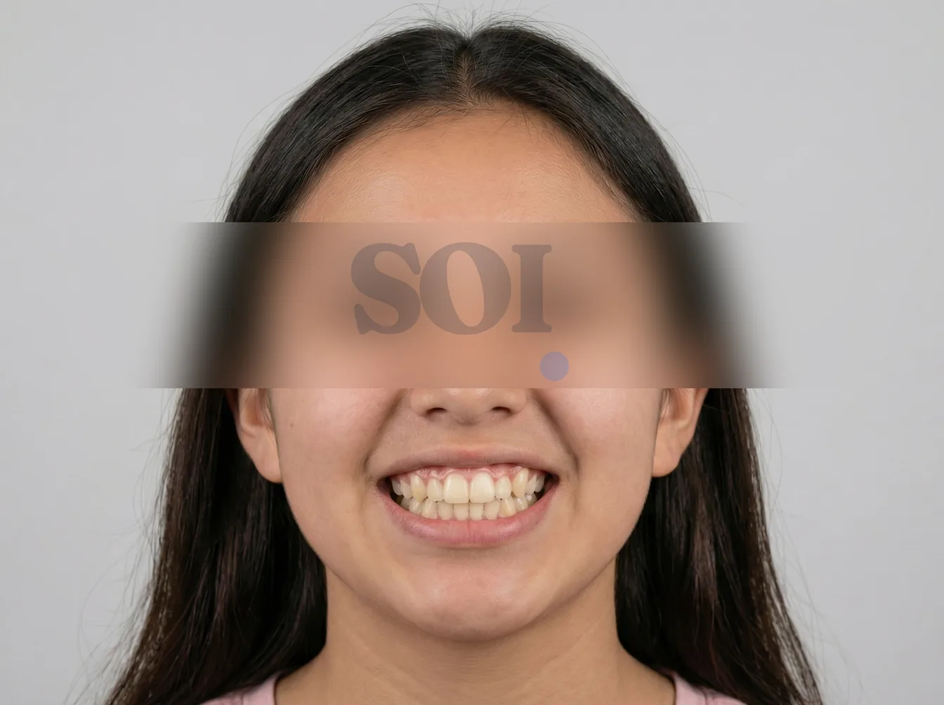 Después del tratamiento de ortodoncia — SOI Quito