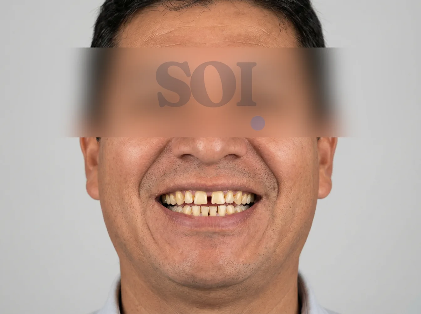 Antes del tratamiento de rehabilitación oral — SOI Quito
