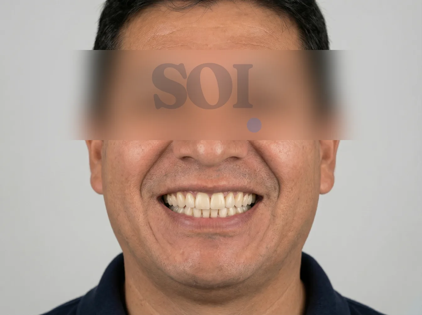 Después del tratamiento de rehabilitación oral — SOI Quito